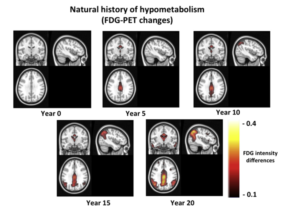 First page of In-Silico Alzheimer's Disease Model abstract